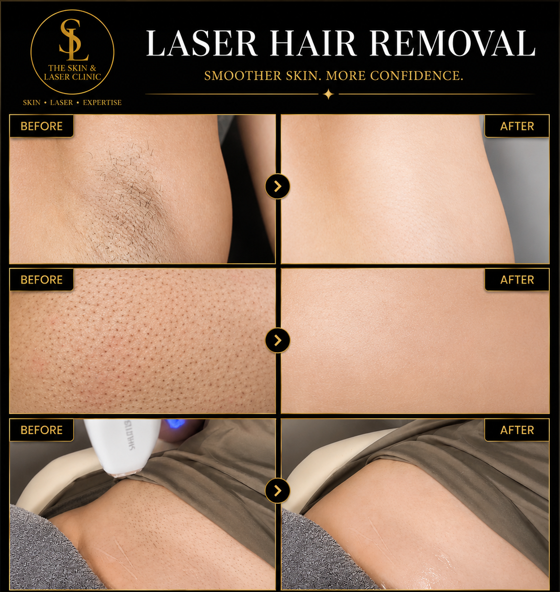 Laser hair removal before and after