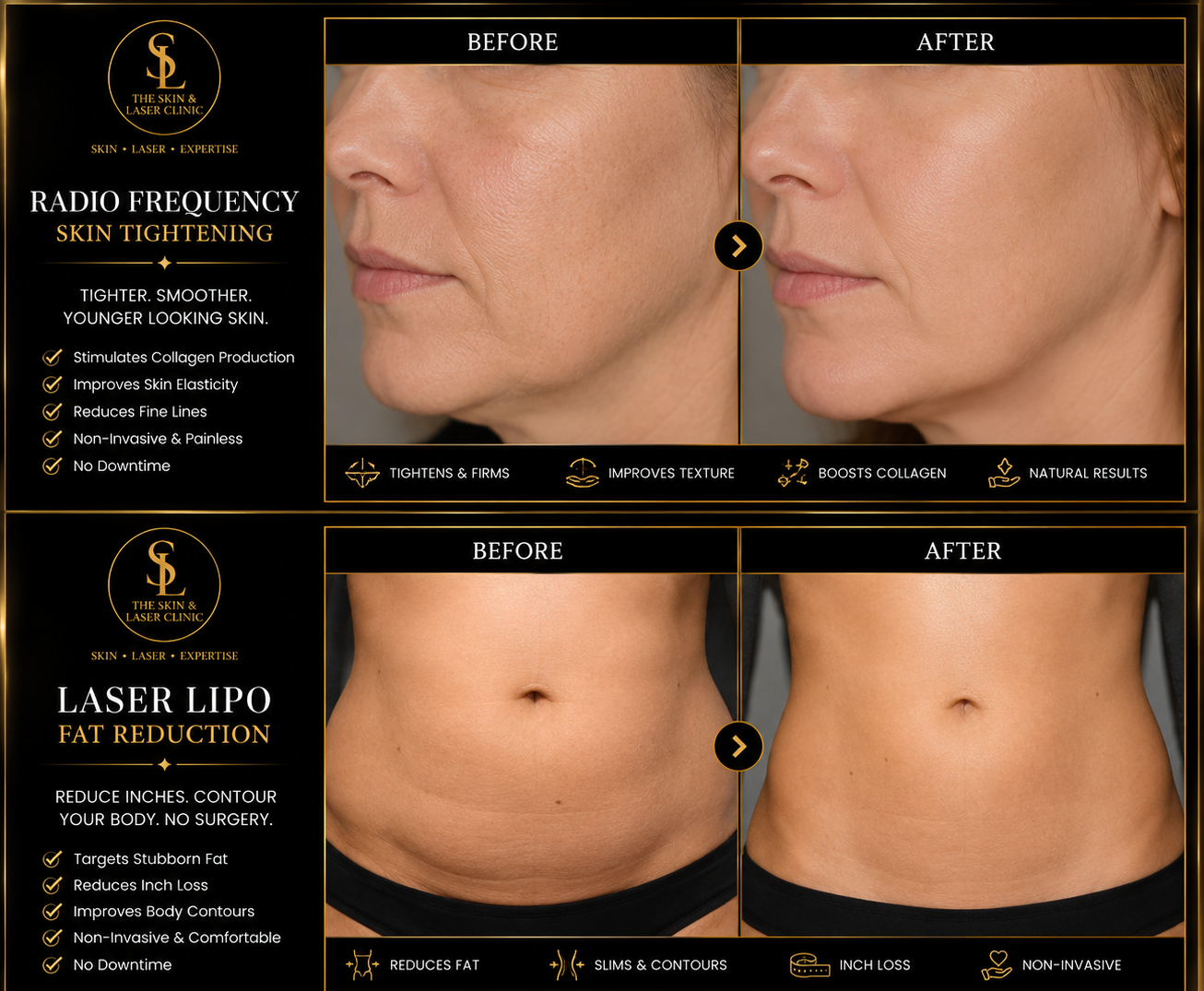 Radio Frequency and Laser Lipo before and after